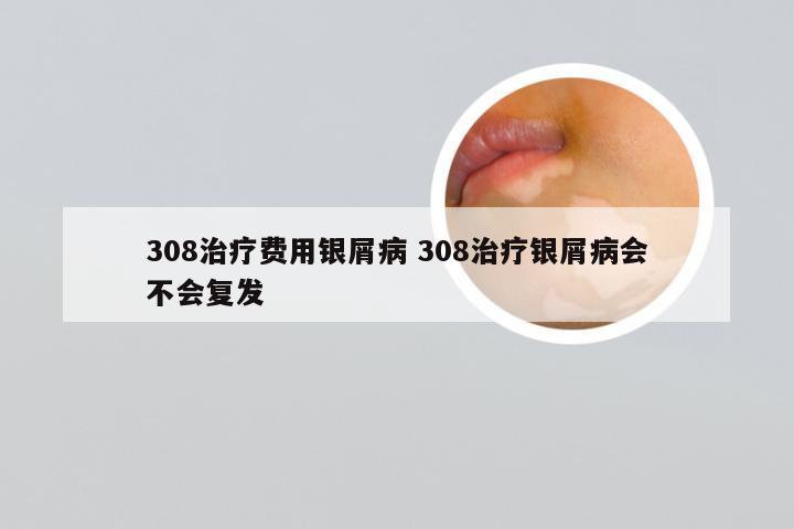 308治疗费用银屑病 308治疗银屑病会不会复发