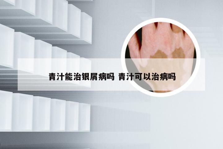 青汁能治银屑病吗 青汁可以治病吗