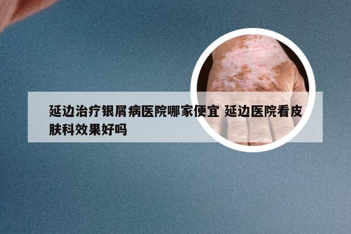 延边治疗银屑病医院哪家便宜 延边医院看皮肤科效果好吗