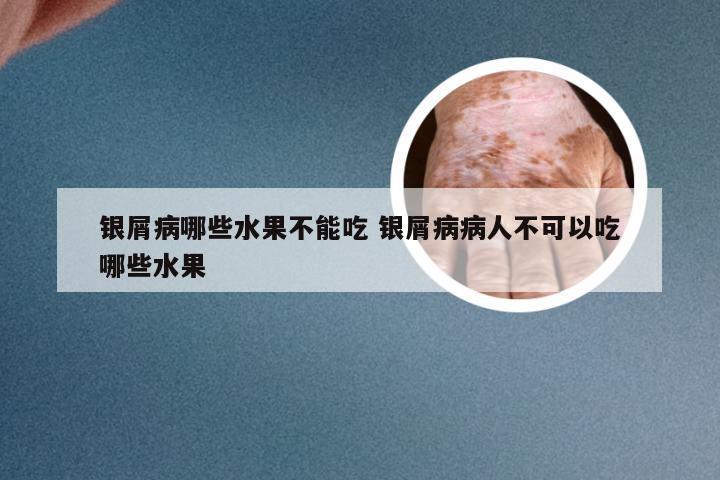 银屑病哪些水果不能吃 银屑病病人不可以吃哪些水果