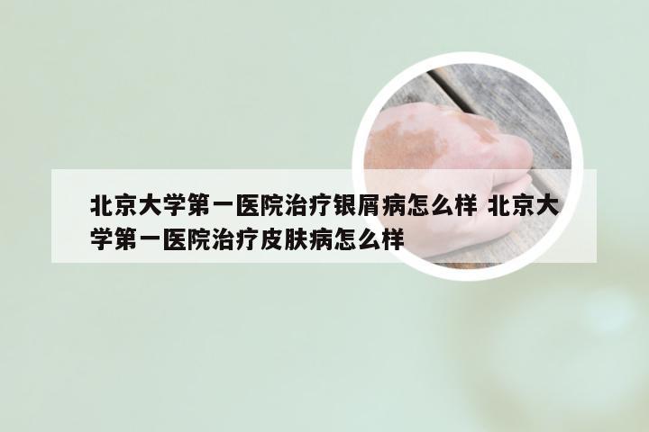 北京大学第一医院治疗银屑病怎么样 北京大学第一医院治疗皮肤病怎么样