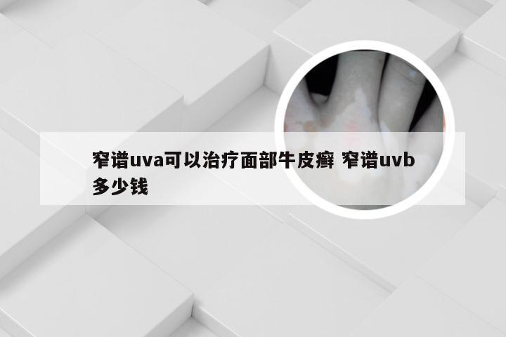 窄谱uva可以治疗面部牛皮癣 窄谱uvb多少钱