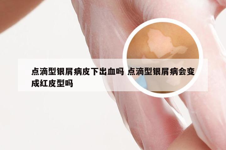 点滴型银屑病皮下出血吗 点滴型银屑病会变成红皮型吗