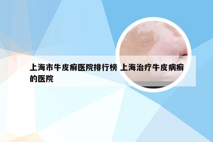 上海市牛皮癣医院排行榜 上海治疗牛皮病癣的医院