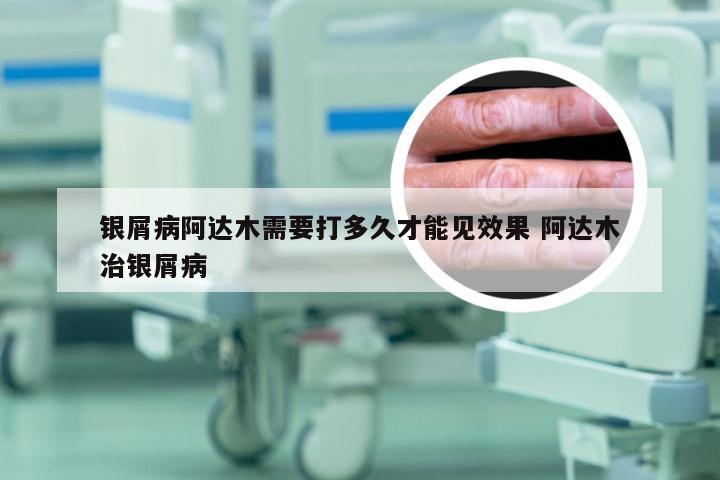 银屑病阿达木需要打多久才能见效果 阿达木治银屑病