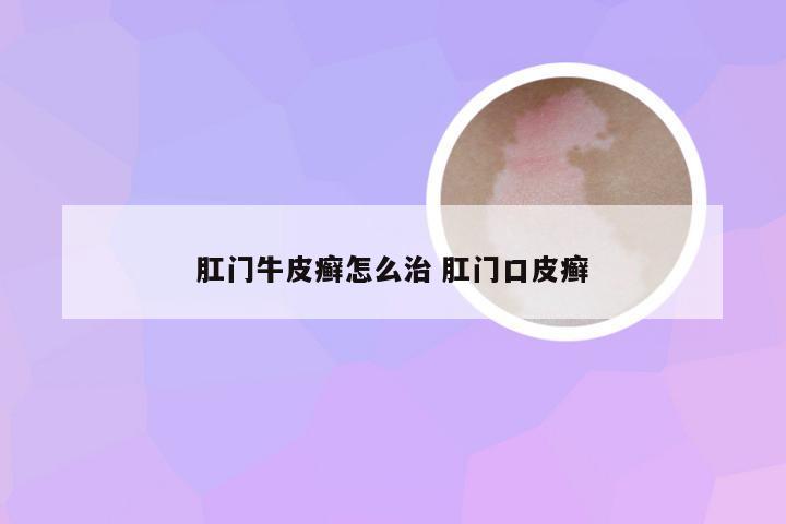 肛门牛皮癣怎么治 肛门口皮癣