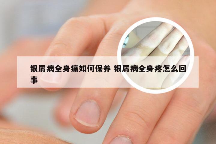 银屑病全身痛如何保养 银屑病全身疼怎么回事