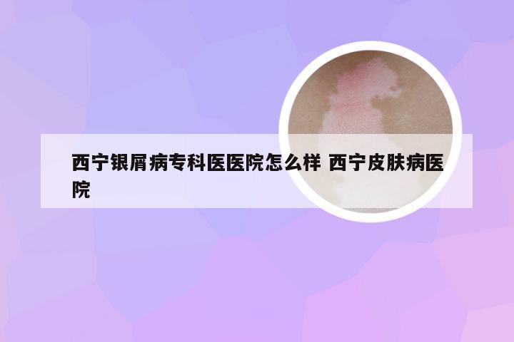 西宁银屑病专科医医院怎么样 西宁皮肤病医院