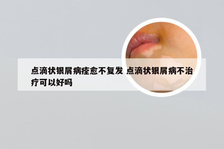 点滴状银屑病痊愈不复发 点滴状银屑病不治疗可以好吗