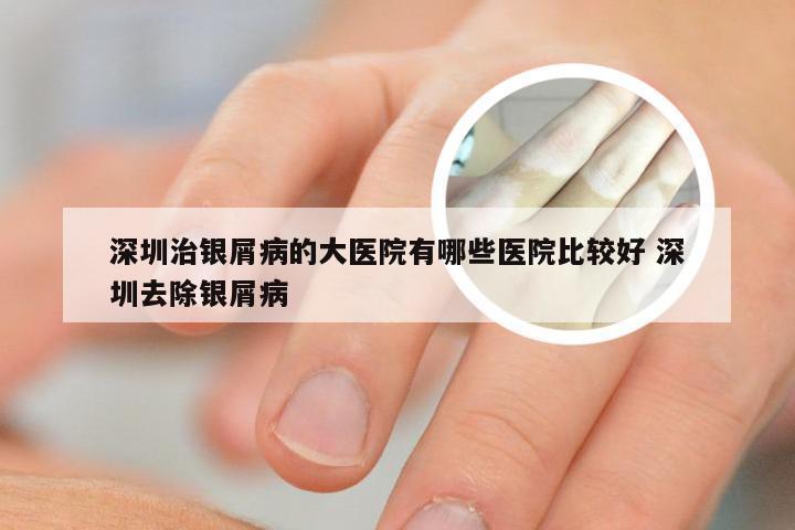 深圳治银屑病的大医院有哪些医院比较好 深圳去除银屑病