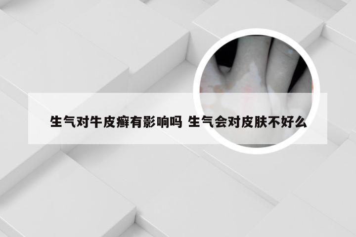 生气对牛皮癣有影响吗 生气会对皮肤不好么