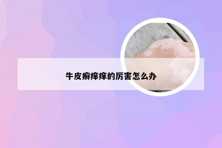 牛皮癣痒痒的厉害怎么办