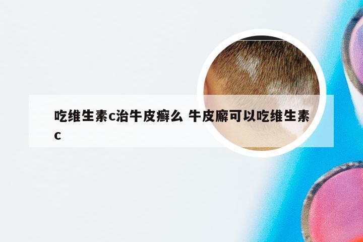 吃维生素c治牛皮癣么 牛皮廨可以吃维生素c