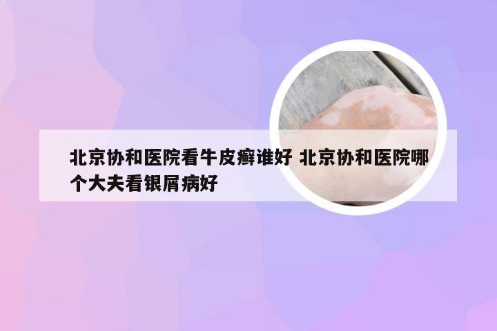 北京协和医院看牛皮癣谁好 北京协和医院哪个大夫看银屑病好