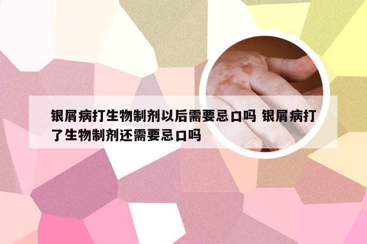 银屑病打生物制剂以后需要忌口吗 银屑病打了生物制剂还需要忌口吗