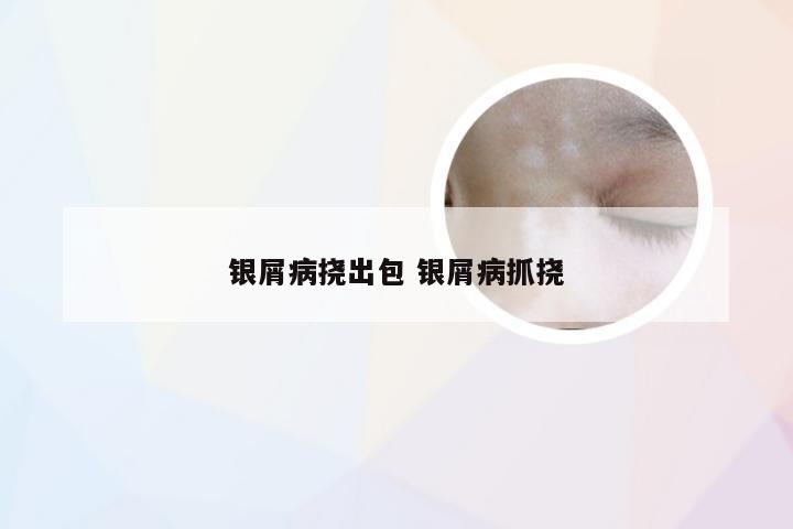 银屑病挠出包 银屑病抓挠