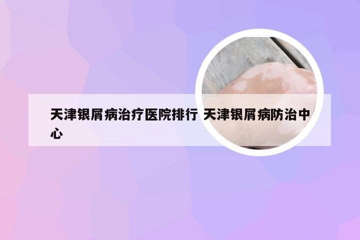 天津银屑病治疗医院排行 天津银屑病防治中心