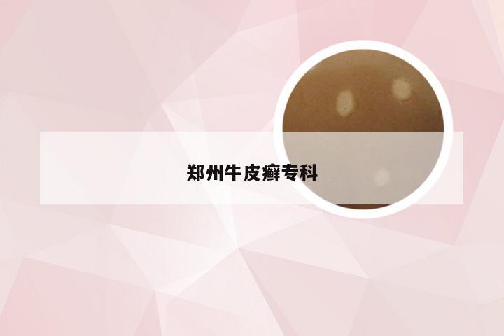 郑州牛皮癣专科