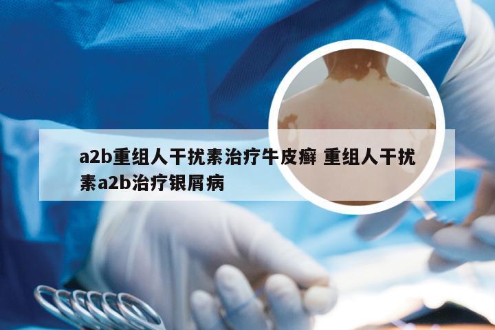 a2b重组人干扰素治疗牛皮癣 重组人干扰素a2b治疗银屑病