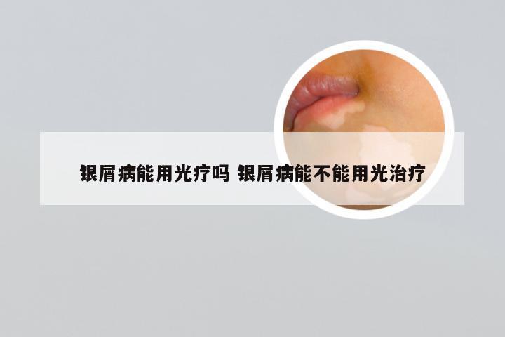 银屑病能用光疗吗 银屑病能不能用光治疗