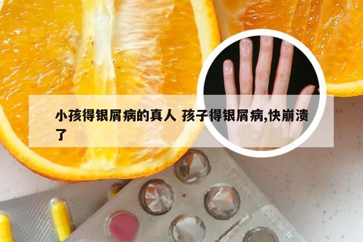 小孩得银屑病的真人 孩子得银屑病,快崩溃了