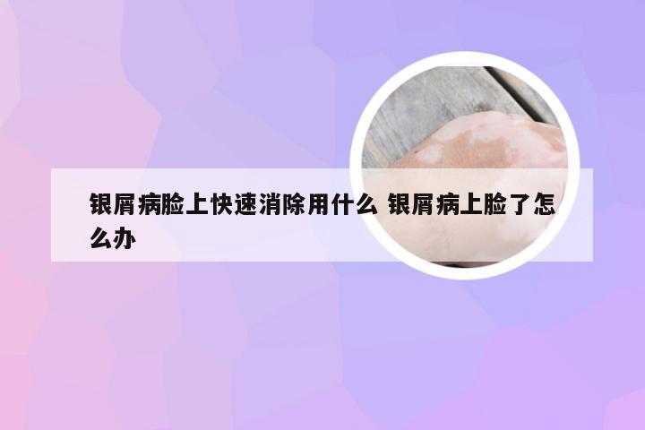 银屑病脸上快速消除用什么 银屑病上脸了怎么办