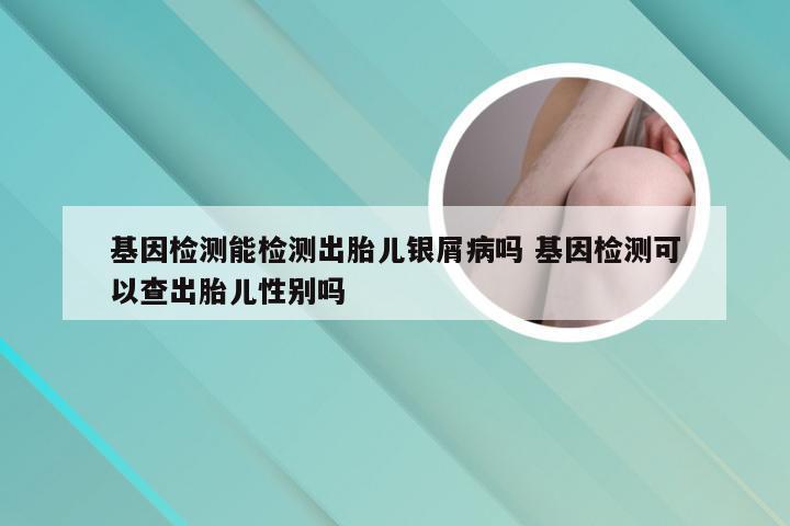 基因检测能检测出胎儿银屑病吗 基因检测可以查出胎儿性别吗