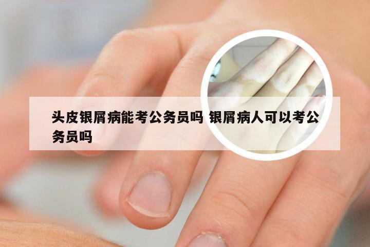 头皮银屑病能考公务员吗 银屑病人可以考公务员吗