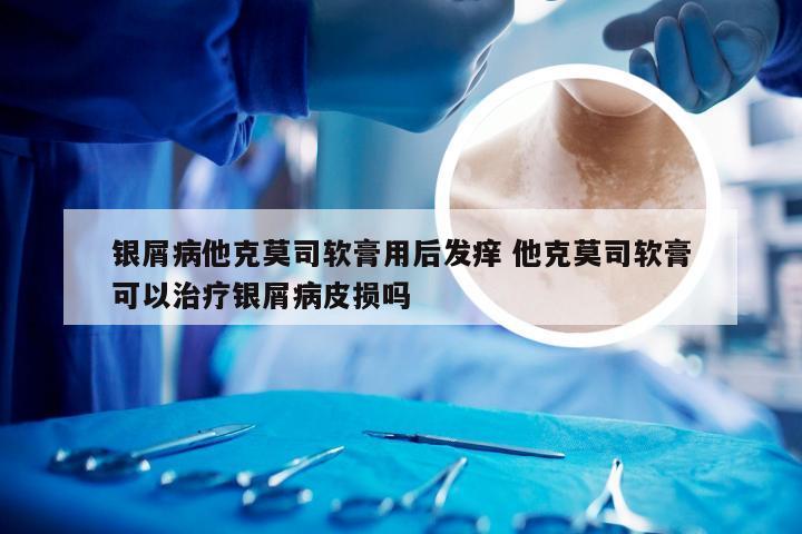 银屑病他克莫司软膏用后发痒 他克莫司软膏可以治疗银屑病皮损吗