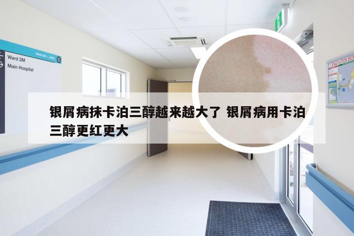 银屑病抹卡泊三醇越来越大了 银屑病用卡泊三醇更红更大