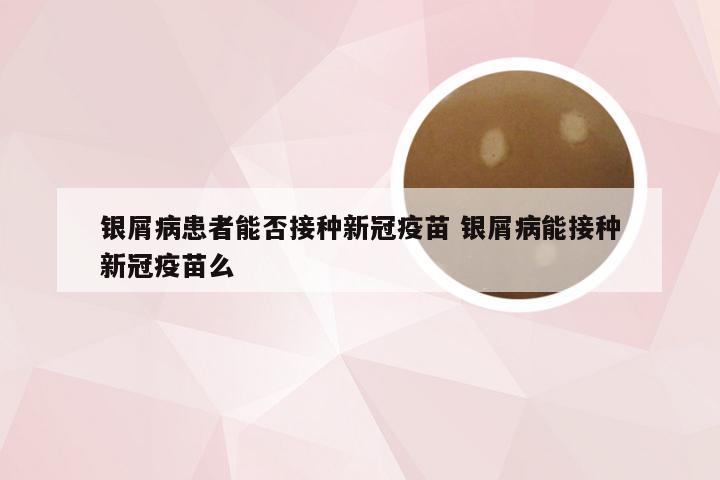 银屑病患者能否接种新冠疫苗 银屑病能接种新冠疫苗么