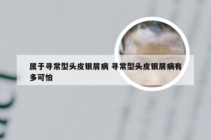 属于寻常型头皮银屑病 寻常型头皮银屑病有多可怕