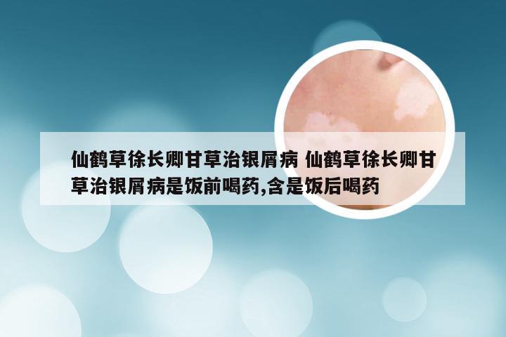 仙鹤草徐长卿甘草治银屑病 仙鹤草徐长卿甘草治银屑病是饭前喝药,含是饭后喝药