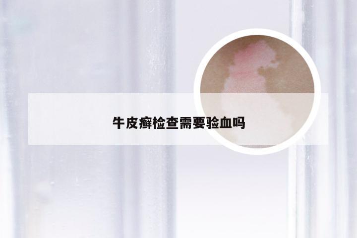 牛皮癣检查需要验血吗