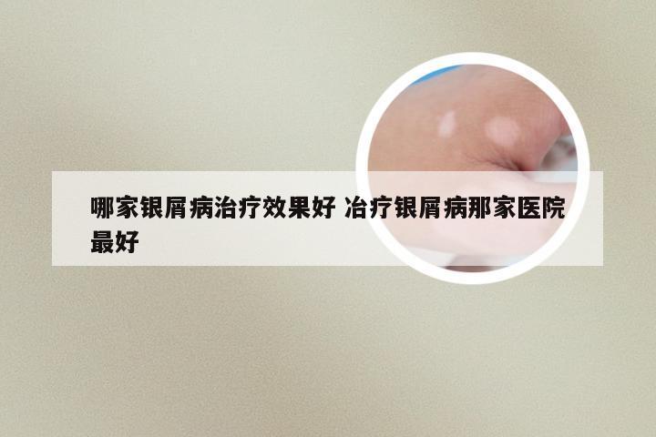 哪家银屑病治疗效果好 冶疗银屑病那家医院最好