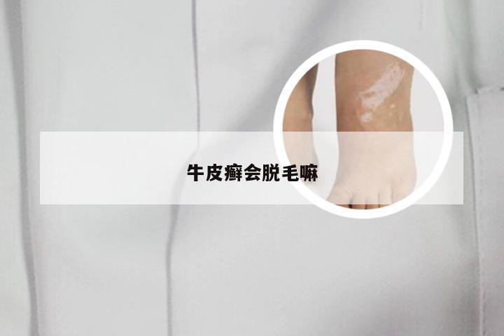 牛皮癣会脱毛嘛