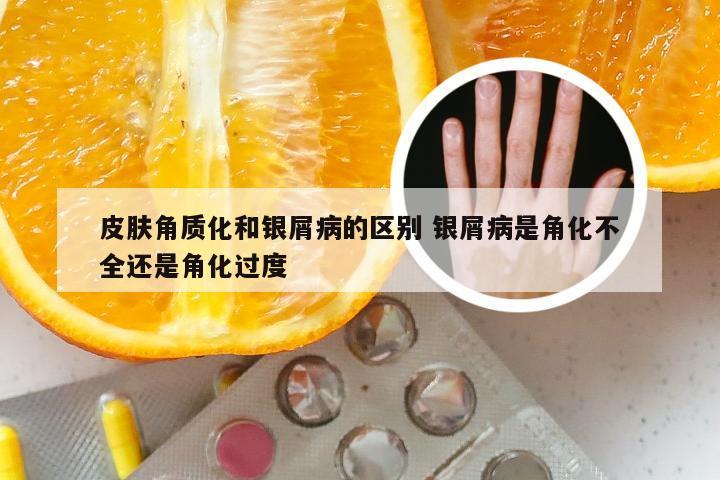 皮肤角质化和银屑病的区别 银屑病是角化不全还是角化过度