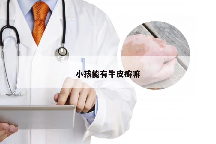 小孩能有牛皮癣嘛