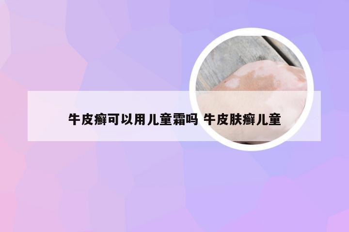 牛皮癣可以用儿童霜吗 牛皮肤癣儿童