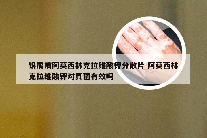 银屑病阿莫西林克拉维酸钾分散片 阿莫西林克拉维酸钾对真菌有效吗
