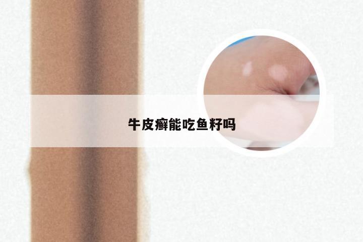 牛皮癣能吃鱼籽吗