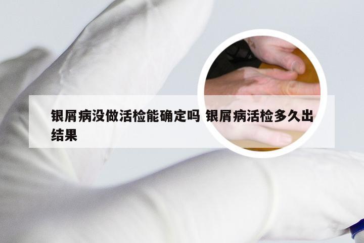 银屑病没做活检能确定吗 银屑病活检多久出结果