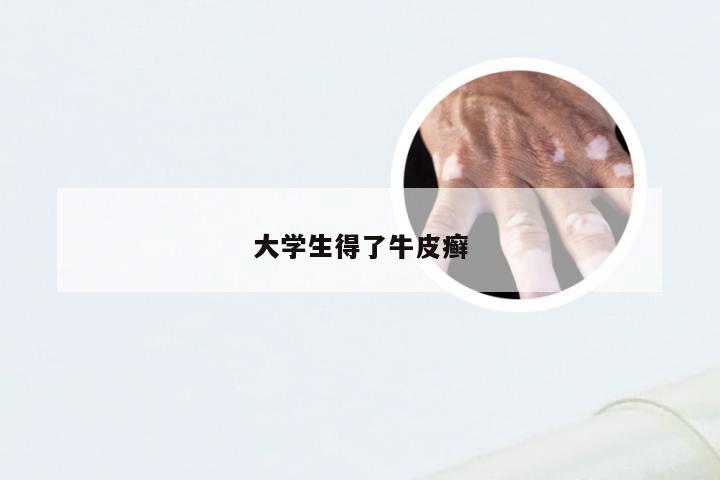 大学生得了牛皮癣
