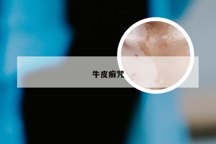 牛皮癣咒