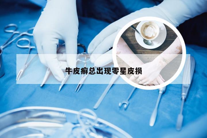 牛皮癣总出现零星皮损