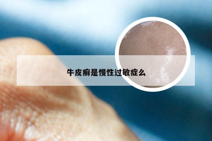 牛皮癣是慢性过敏症么