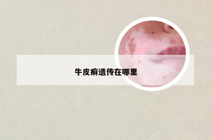 牛皮癣遗传在哪里