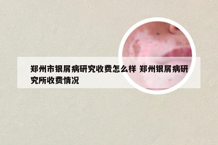 郑州市银屑病研究收费怎么样 郑州银屑病研究所收费情况