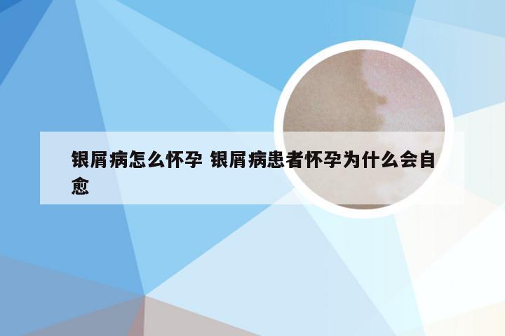 银屑病怎么怀孕 银屑病患者怀孕为什么会自愈