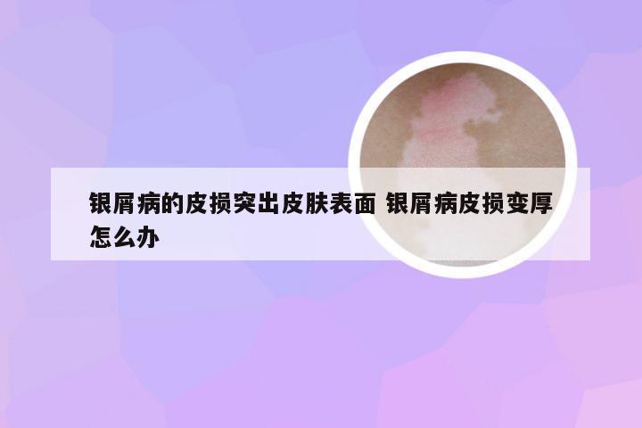 银屑病的皮损突出皮肤表面 银屑病皮损变厚怎么办